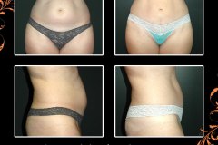 abdominoplasty-2652