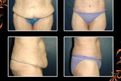 abdominoplasty-2679