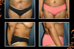 abdominoplasty-2688