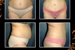 abdominoplasty-2706