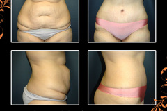 abdominoplasty-2708