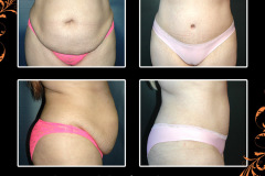 abdominoplasty-2751