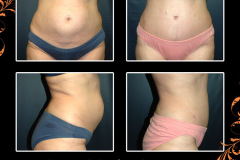 abdominoplasty-2775