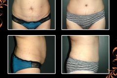 abdominoplasty-2841