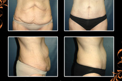 abdominoplasty-2847