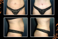 abdominoplasty-2893