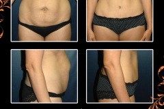 abdominoplasty-3070