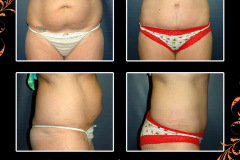 abdominoplasty-3097