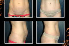 abdominoplasty-3108