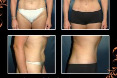 abdominoplasty-3157