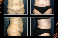 abdominoplasty-3186