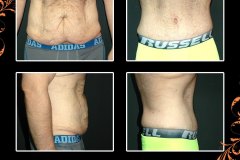 abdominoplasty-3409