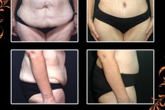 abdominoplasty-3586