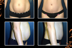 abdominoplasty-3659