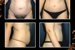 abdominoplasty-3744