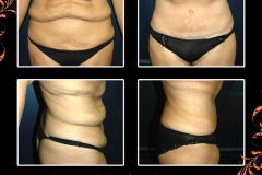 abdominoplasty-3748