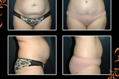 abdominoplasty-3842