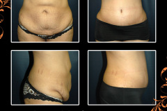 abdominoplasty-3872