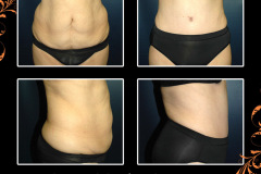 abdominoplasty-3990