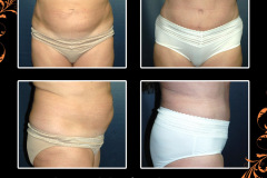 abdominoplasty-4571