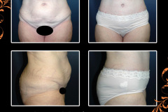abdominoplasty-4639