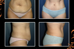 abdominoplasty-4827