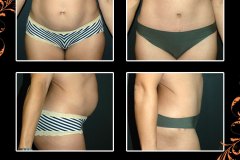 abdominoplasty-4904