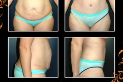 abdominoplasty-4966