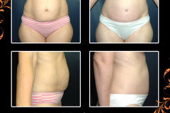 abdominoplasty-5060