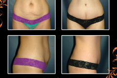 abdominoplasty-5170