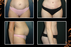 abdominoplasty-5191