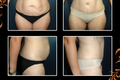 abdominoplasty-5212