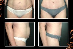 abdominoplasty-5234