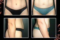 abdominoplasty-5353