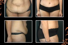 abdominoplasty-6139