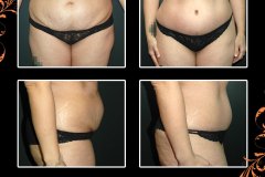abdominoplasty-6140