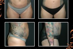 abdominoplasty-6164