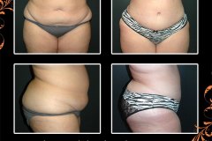 abdominoplasty-6171