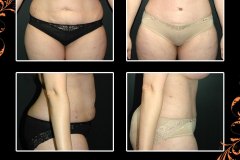 abdominoplasty-6190
