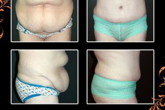 abdominoplasty-6202