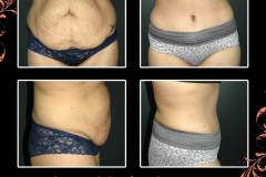 abdominoplasty-6219
