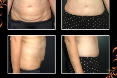 abdominoplasty-6225