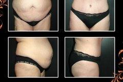 abdominoplasty-6244