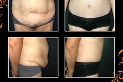 abdominoplasty-6248