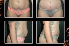abdominoplasty-6249