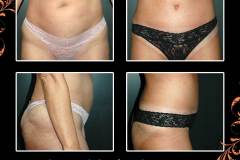 abdominoplasty-6300
