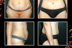 abdominoplasty-6302