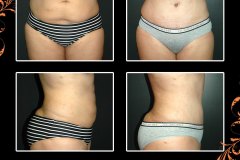 abdominoplasty-6311