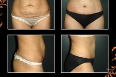 abdominoplasty-6328
