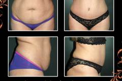 abdominoplasty-6329